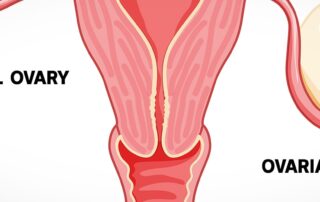 what-are-ovarian-cysts-and-what-symptoms-should-you-look-for?