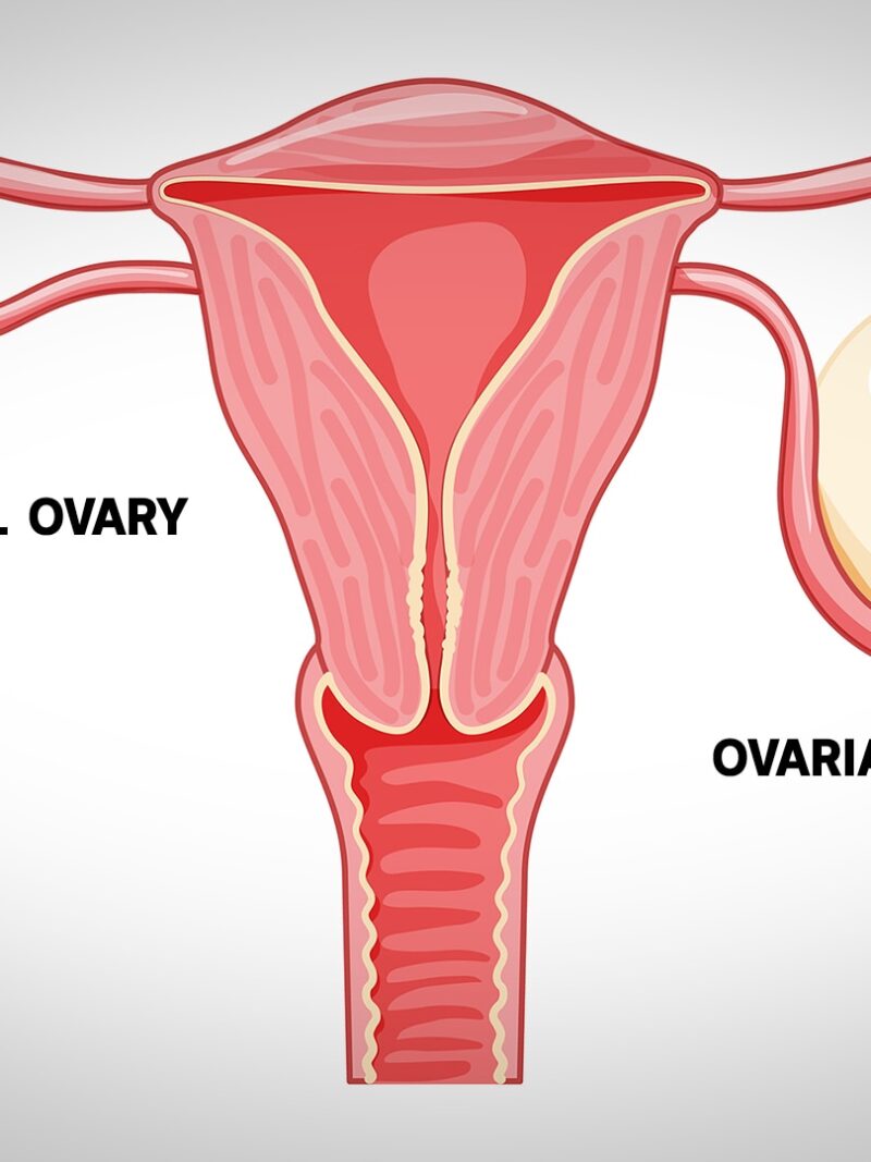 What Are Ovarian Cysts And What Symptoms Should You Look For Sa