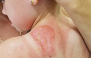 spike-in-severe-sunburn-cases-at-hospital-burns-unit-prompts-warning