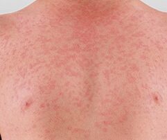 sa-records-first-measles-case-in-three-years,-with-more-expected-as-global-case-numbers-grow
