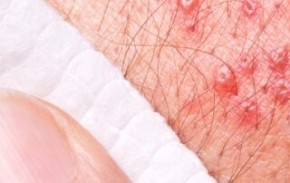 federal-government-makes-new-shingles-vaccine-free-for-older-australians-from-november-1