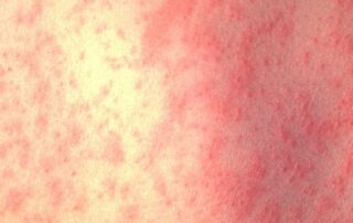 sa-health-releases-exposure-sites-after-teenager-tests-positive-to-measles