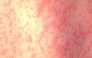 measles-case-reported-in-adelaide-boy-who-recently-returned-from-overseas